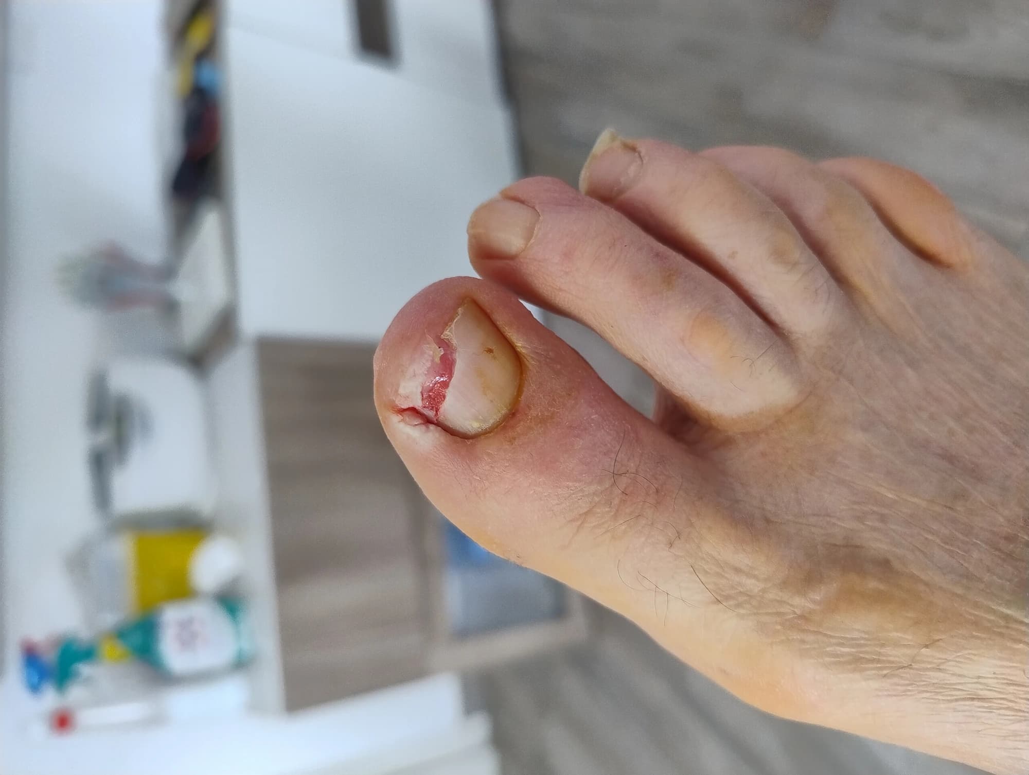 Onicocriptosi con onicolisi e lesione granulomatosa del letto ungueale — immagine clinica