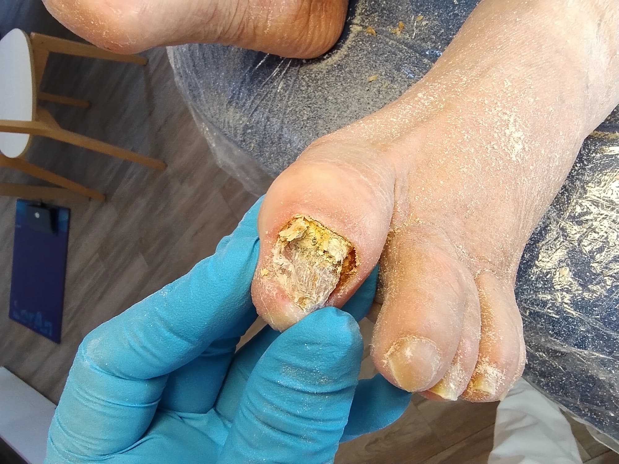 Onicomicosi severa: fase di rimozione della lamina ungueale infetta — immagine clinica