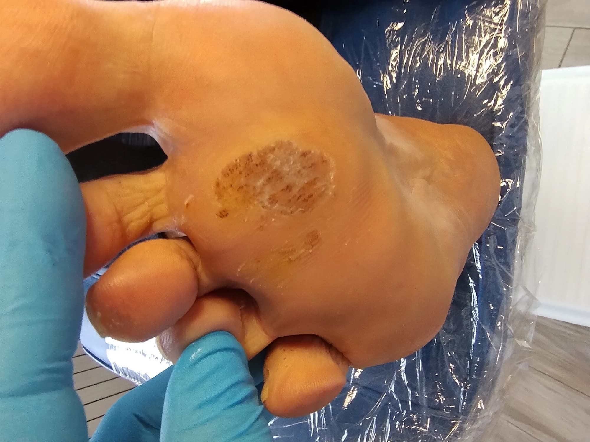 Verruche plantari diffuse: manifestazione clinica del papillomavirus a livello plantare